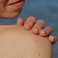 6 Tips to Prevent Skin Cancer: Lifestyle Changes to Consider