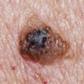 Understanding the Risk Factors of Melanoma Skin Cancer