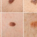 Understanding Melanoma: What You Need to Know