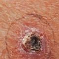 Treating Basal Cell Carcinoma: A Comprehensive Guide