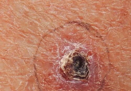 A Comprehensive Guide to Types of Skin Cancer