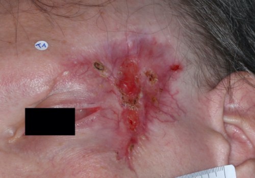 Understanding the Risk Factors of Basal Cell Carcinoma
