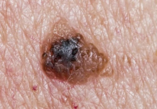 Understanding the Risk Factors of Melanoma Skin Cancer