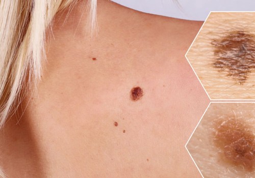 What You Need to Know About Melanoma Skin Cancer