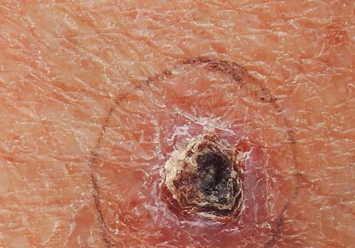 Understanding Basal Cell Carcinoma: Prognosis and Treatment
